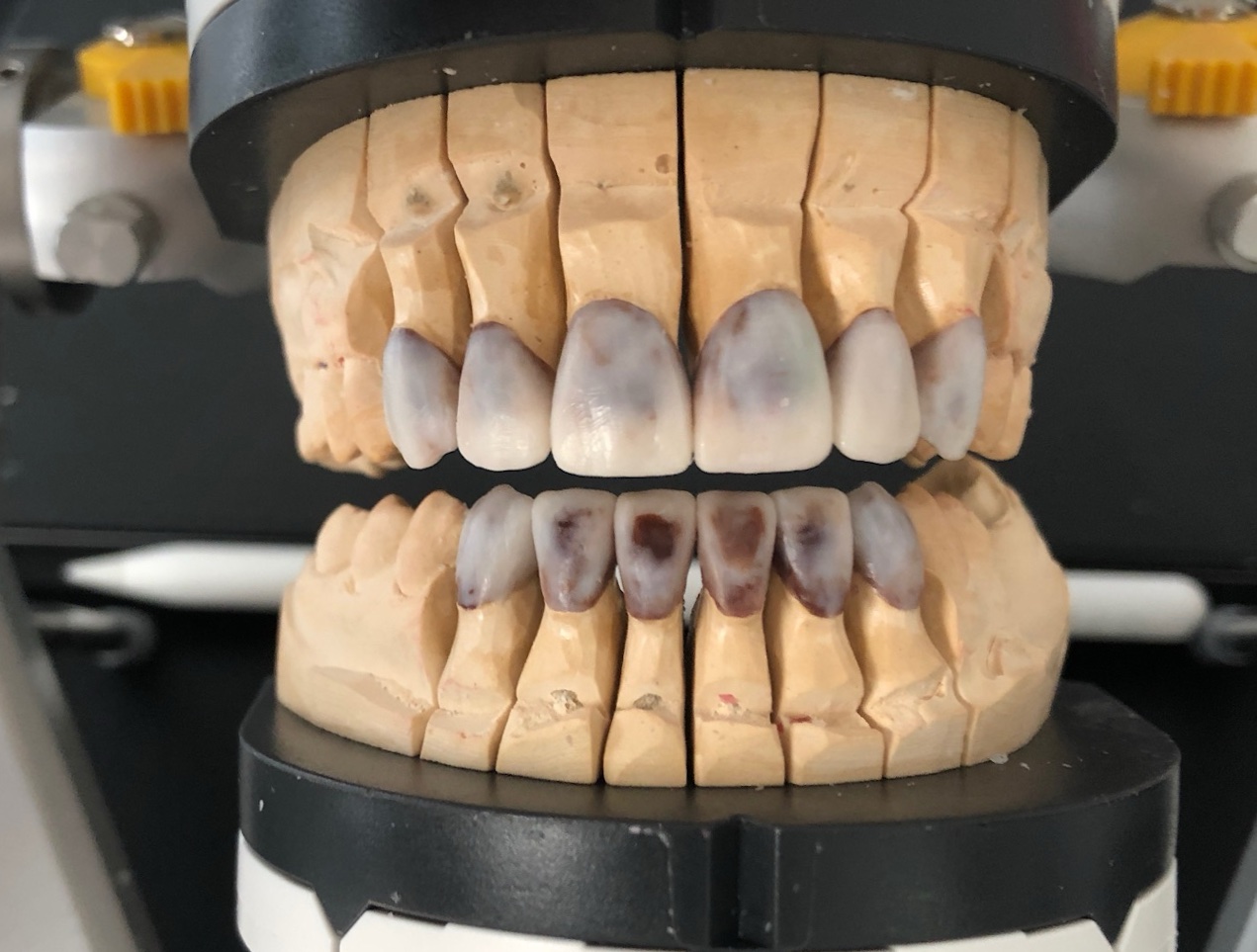 OK/UK Frontzahn-Veneers – Stümpfe