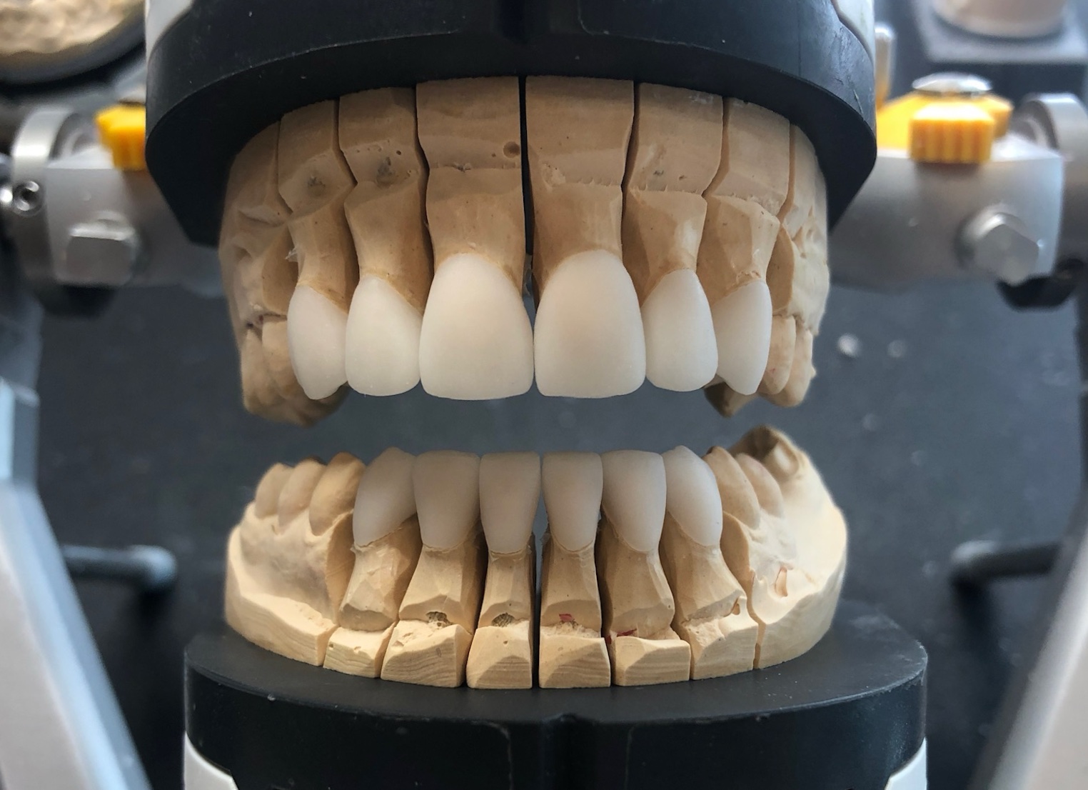 OK/UK Frontzahn-Veneers – Rohbrand