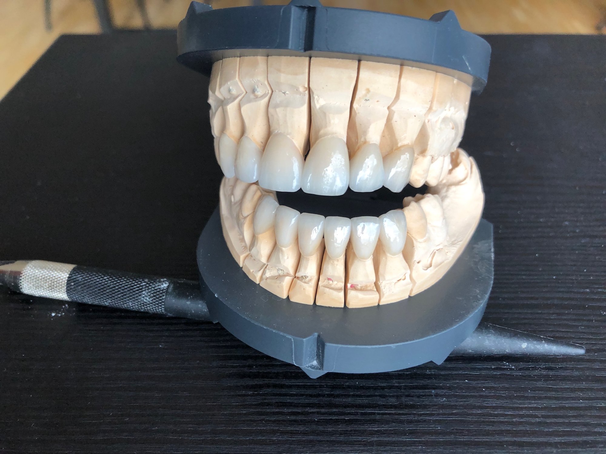 OK/UK Frontzahn-Veneers – Fertig