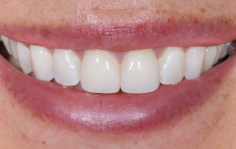 Veneer-Erneuerung – Nachher