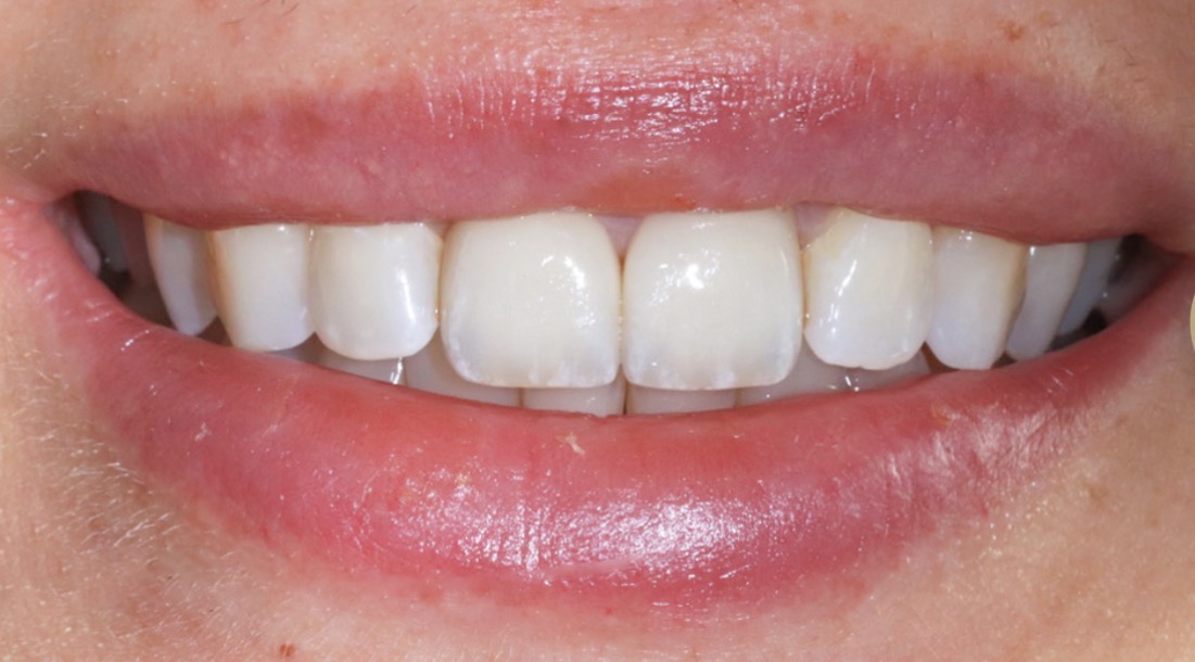 Veneer-Erneuerung – Vorher