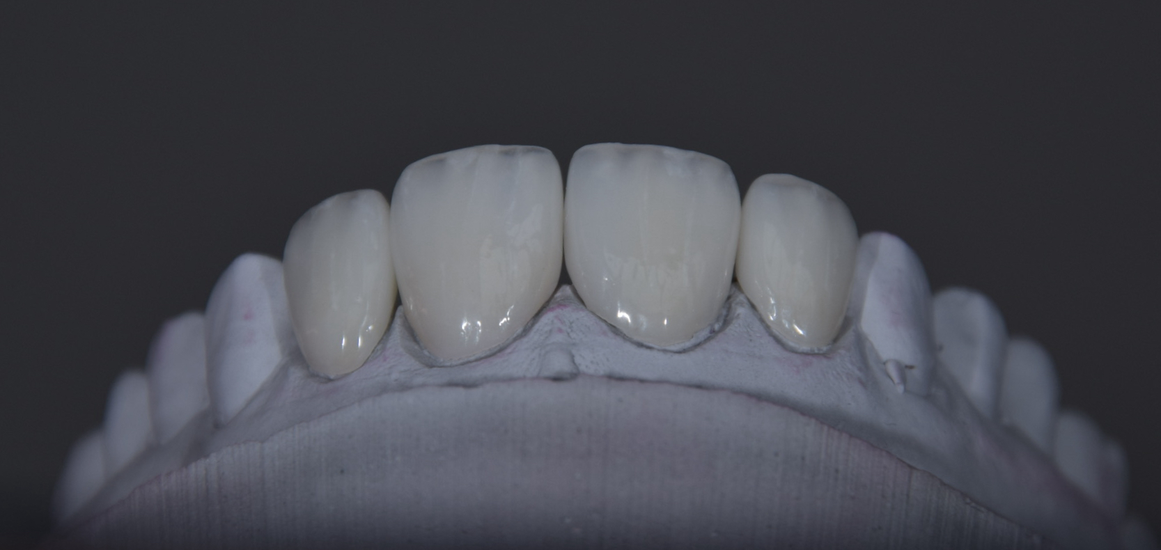 Vollkeramik-Restauration