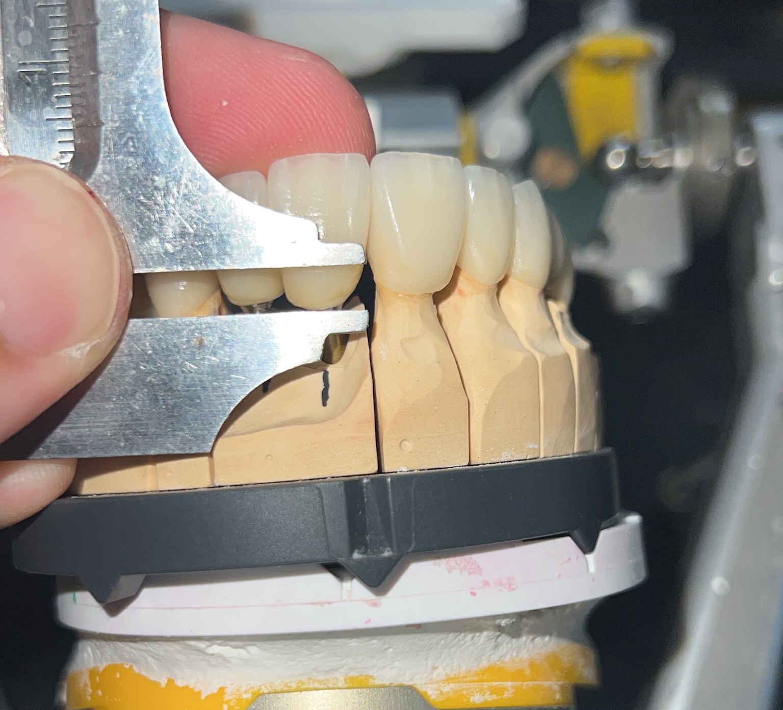 Weitere Arbeiten – Implantatbrücke Seitenzahn