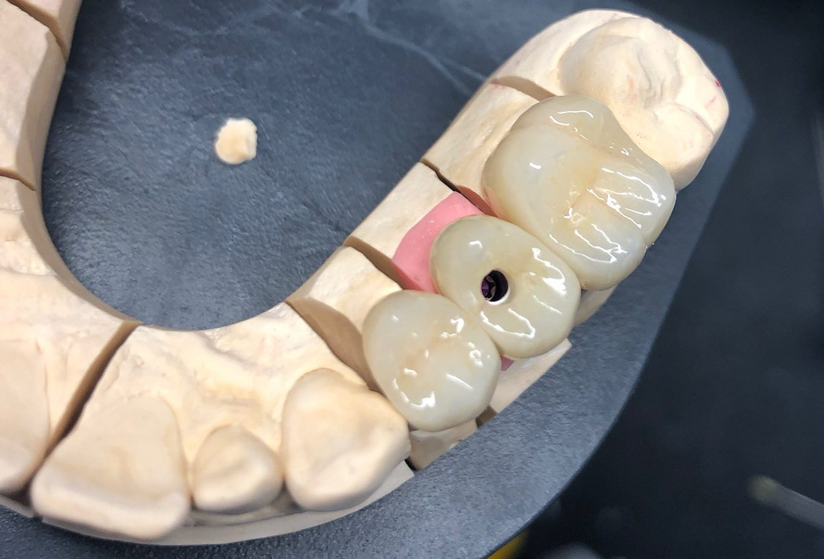 Weitere Arbeiten – Implantatprothese UK