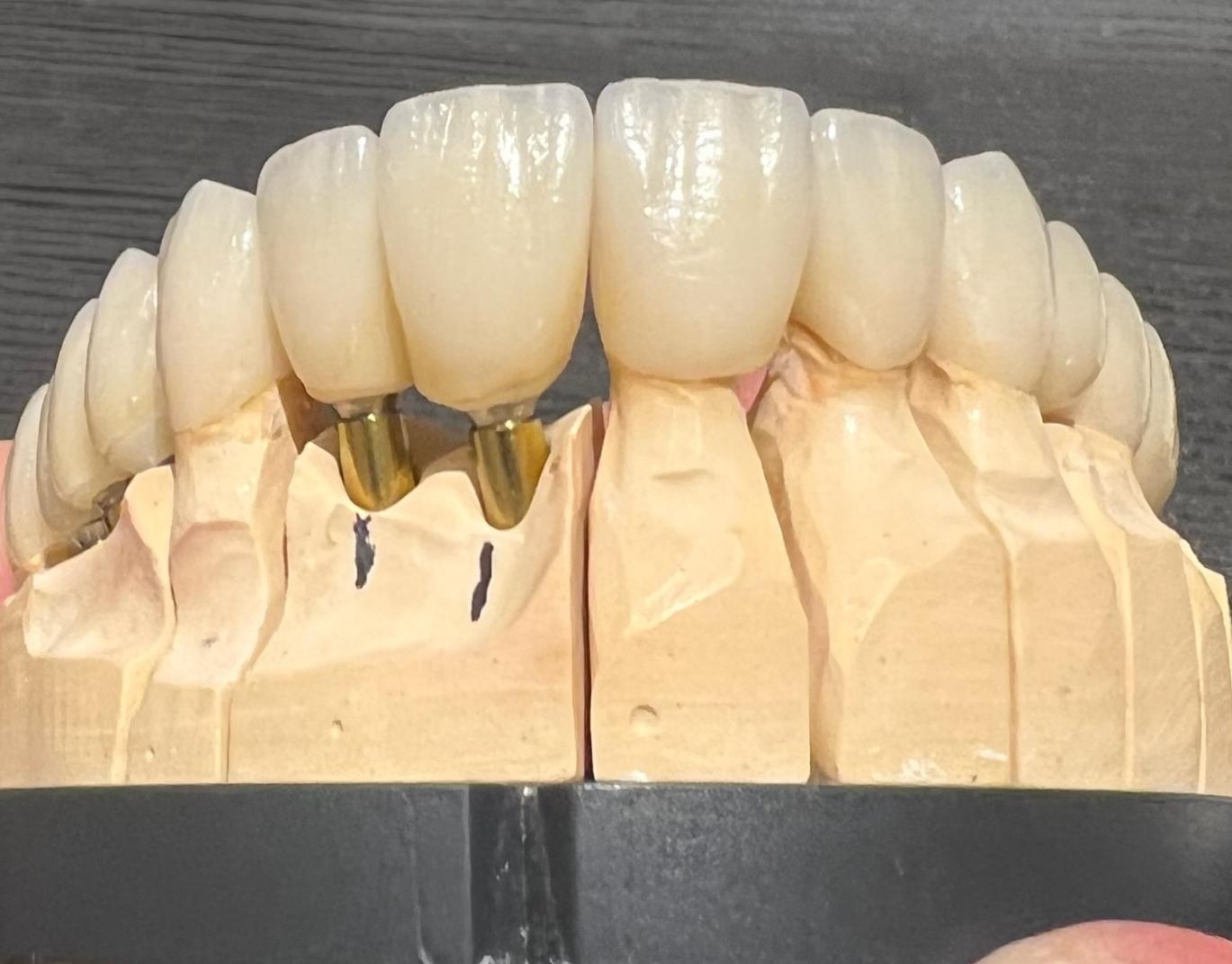 Weitere Arbeiten – Frontzahn-Veneer Modell