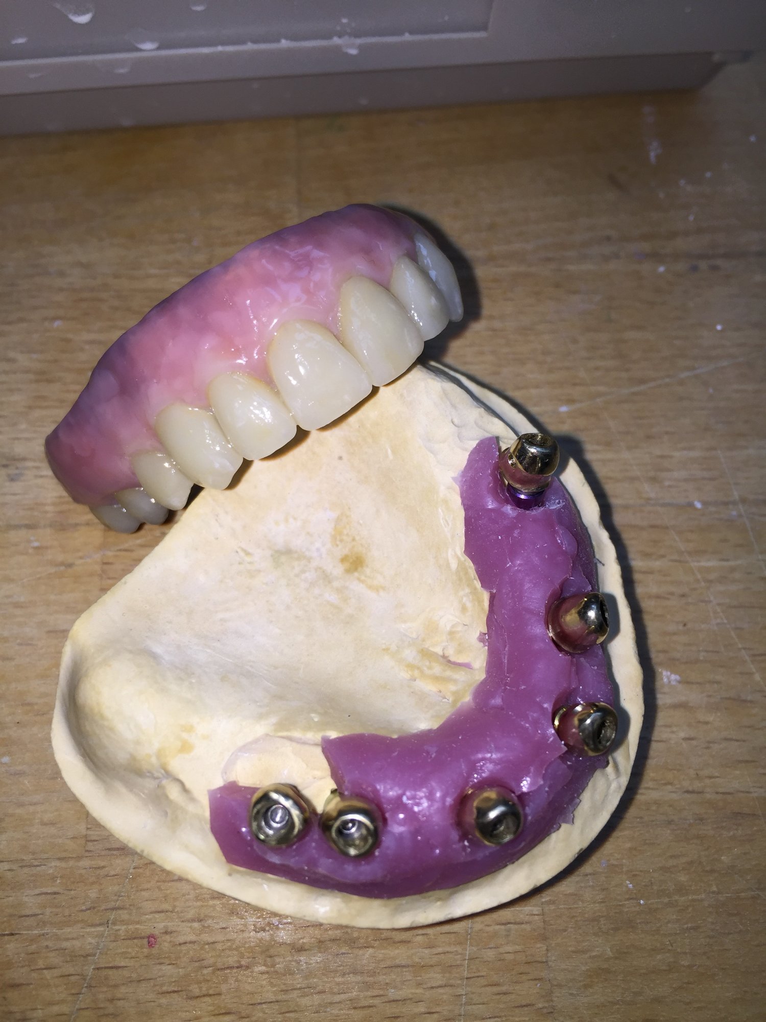 Weitere Arbeiten – Frontzahnbrücke palatinal