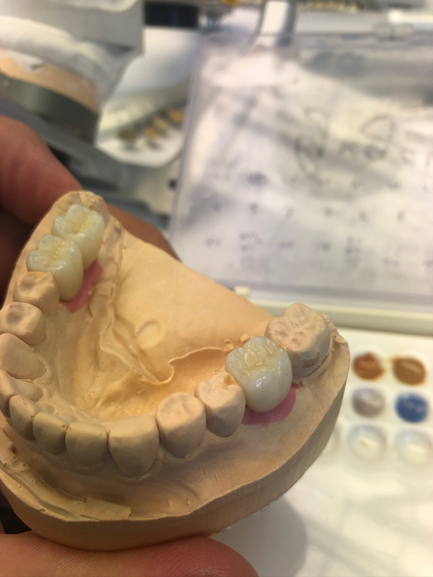 Weitere Arbeiten – Seitenzahnbrücke intraoral