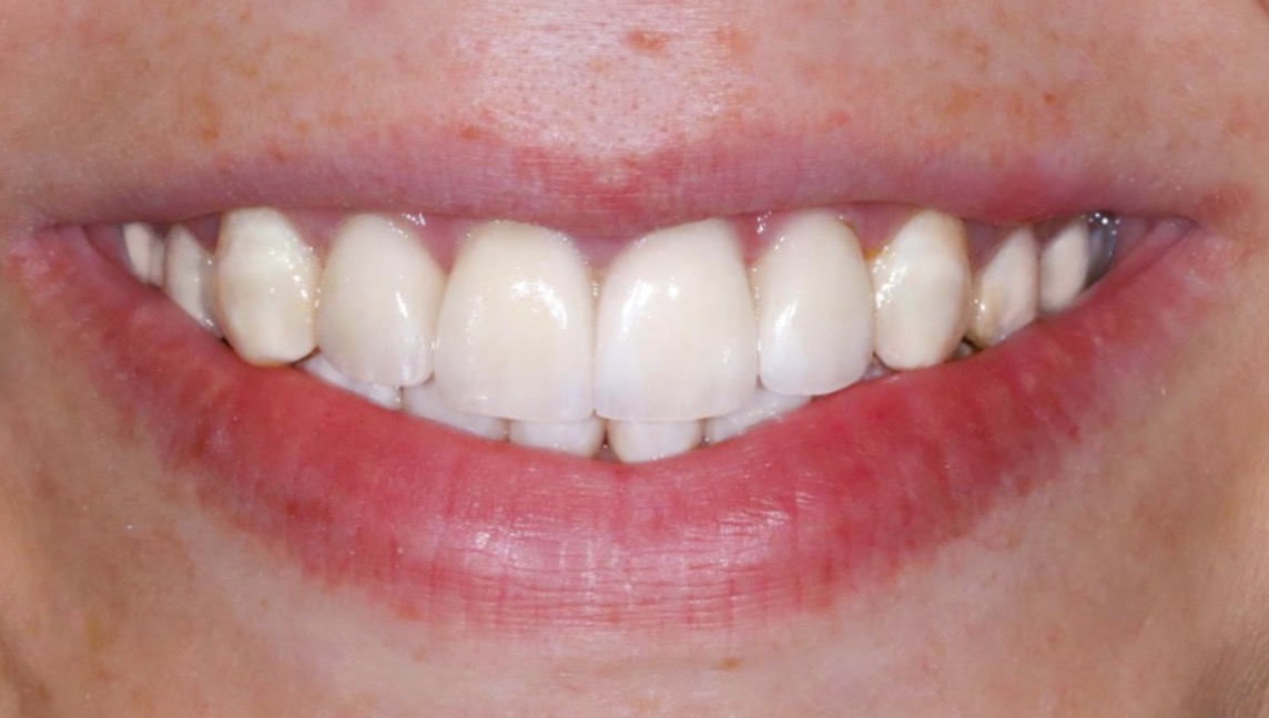 Tetracyclin-Veneers – Nachher
