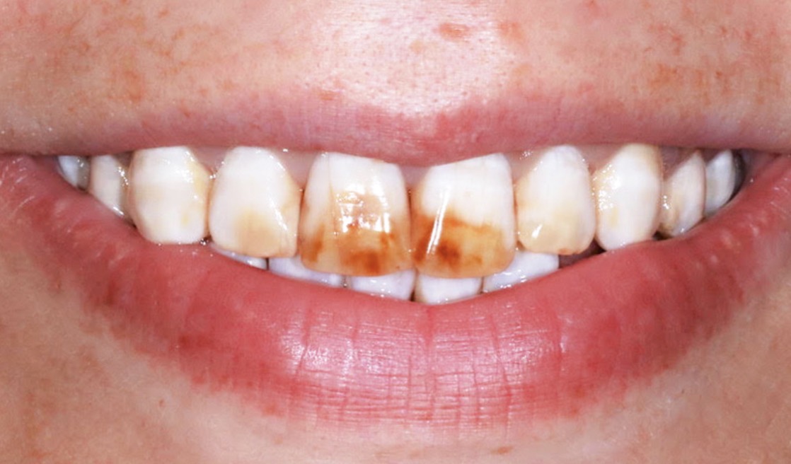 Tetracyclin-Veneers – Vorher