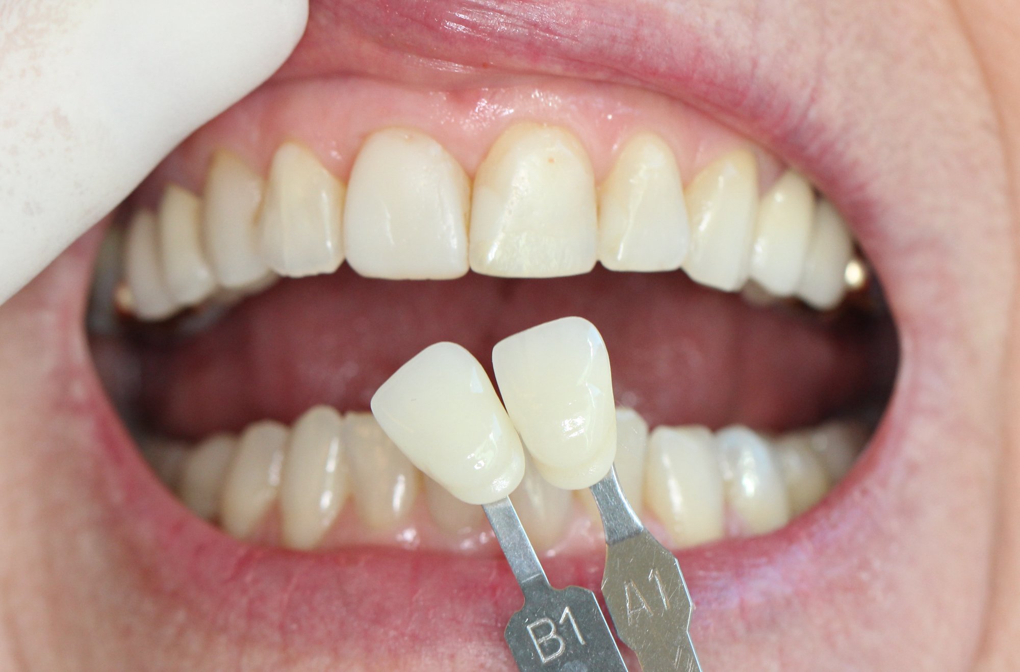 Veneers – Farbbestimmung