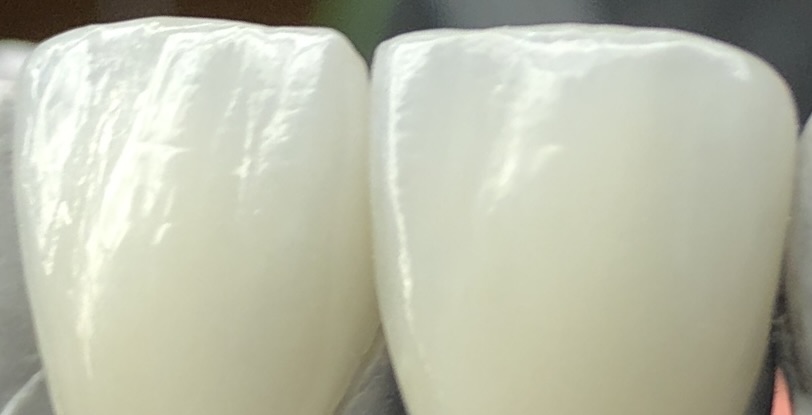 Veneers – Detail