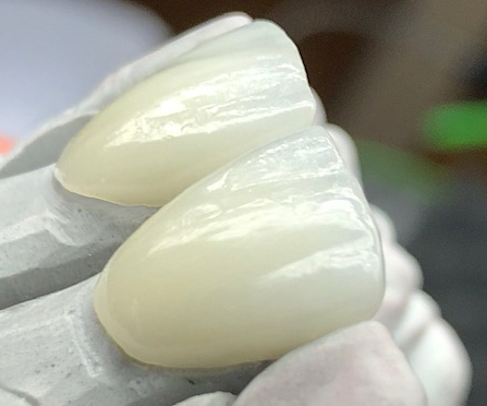 Veneers – Modell seitlich