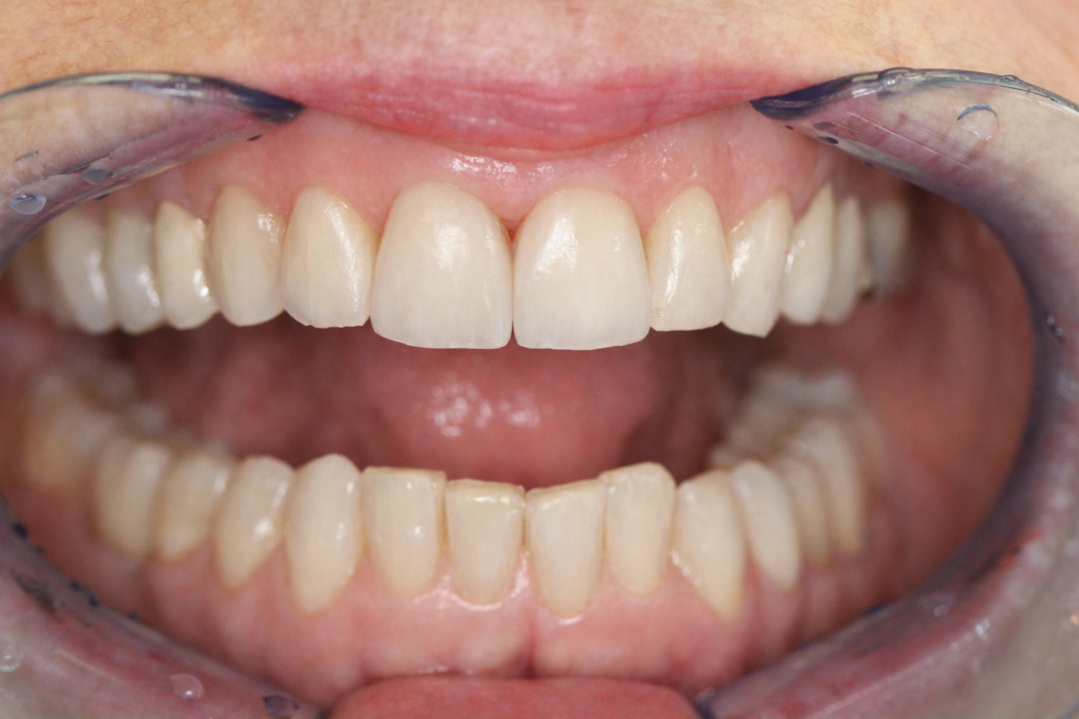 Veneers – Ergebnis