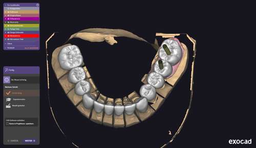 UK Herstellung – Okklusalansicht