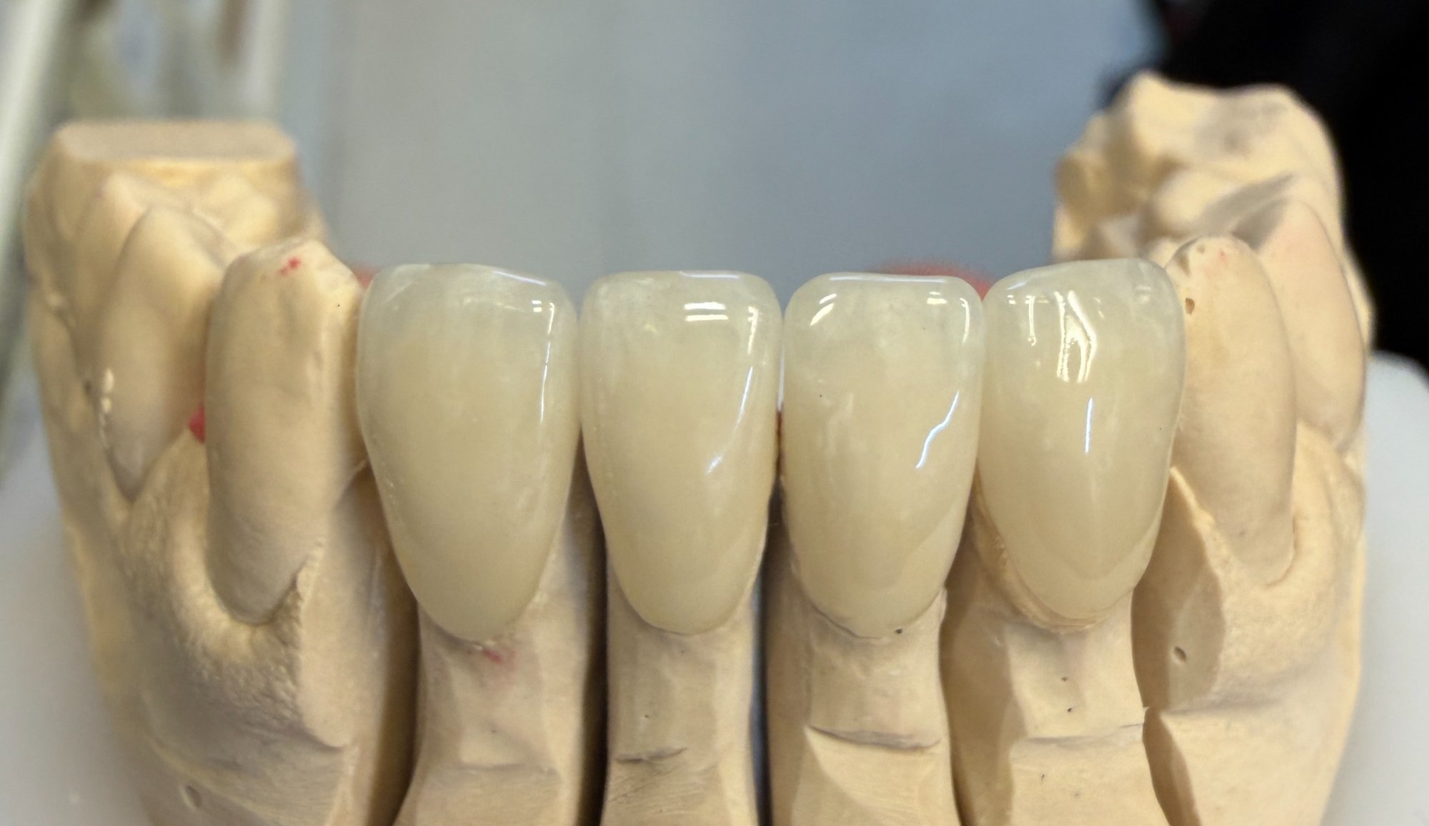 Veneers – Modell 1