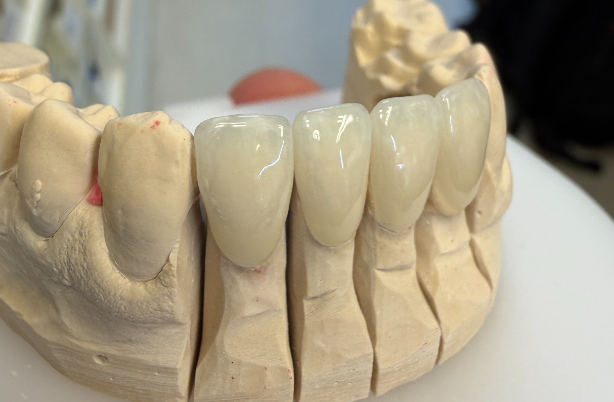 Veneers – Modell 2