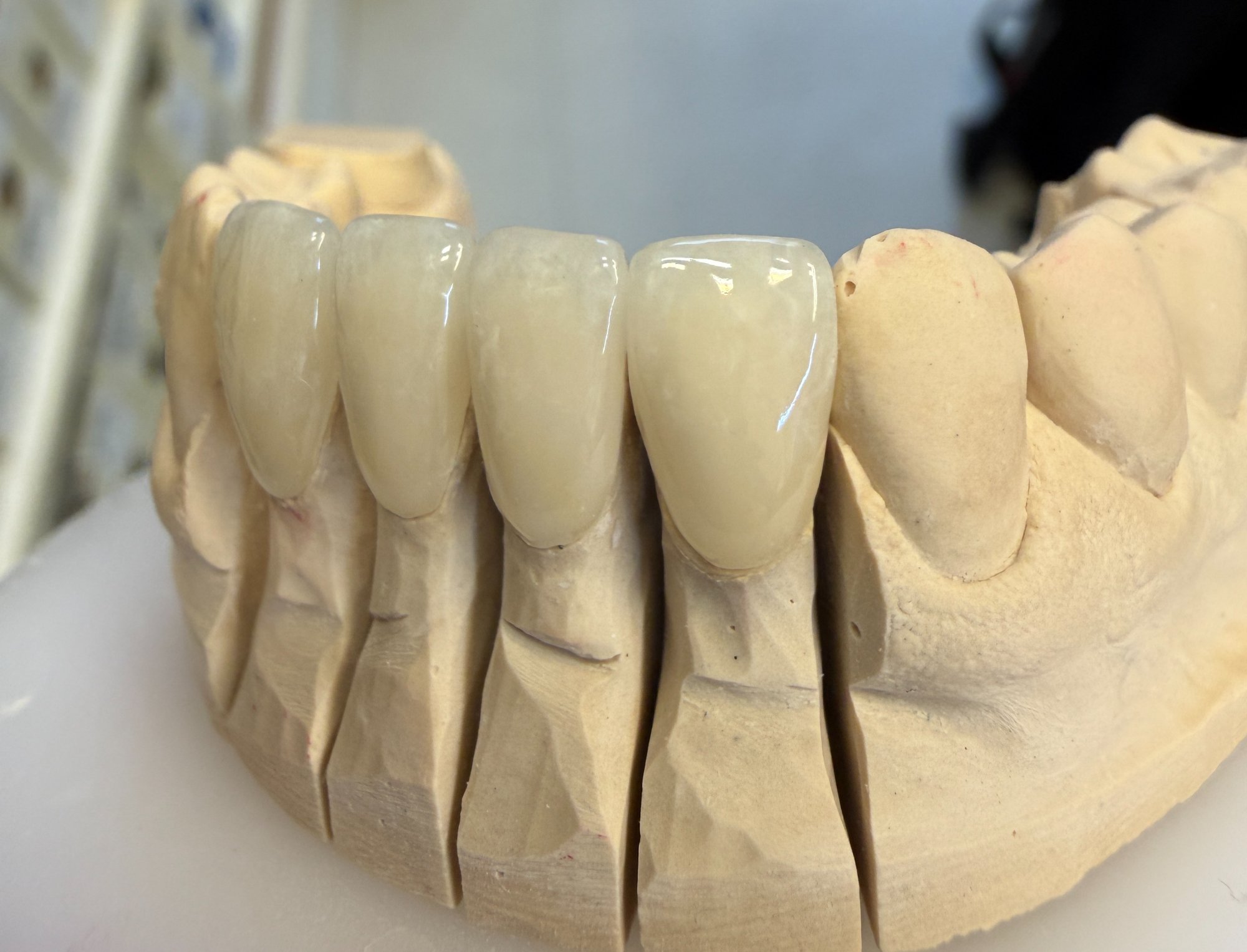 Veneers – Modell 3