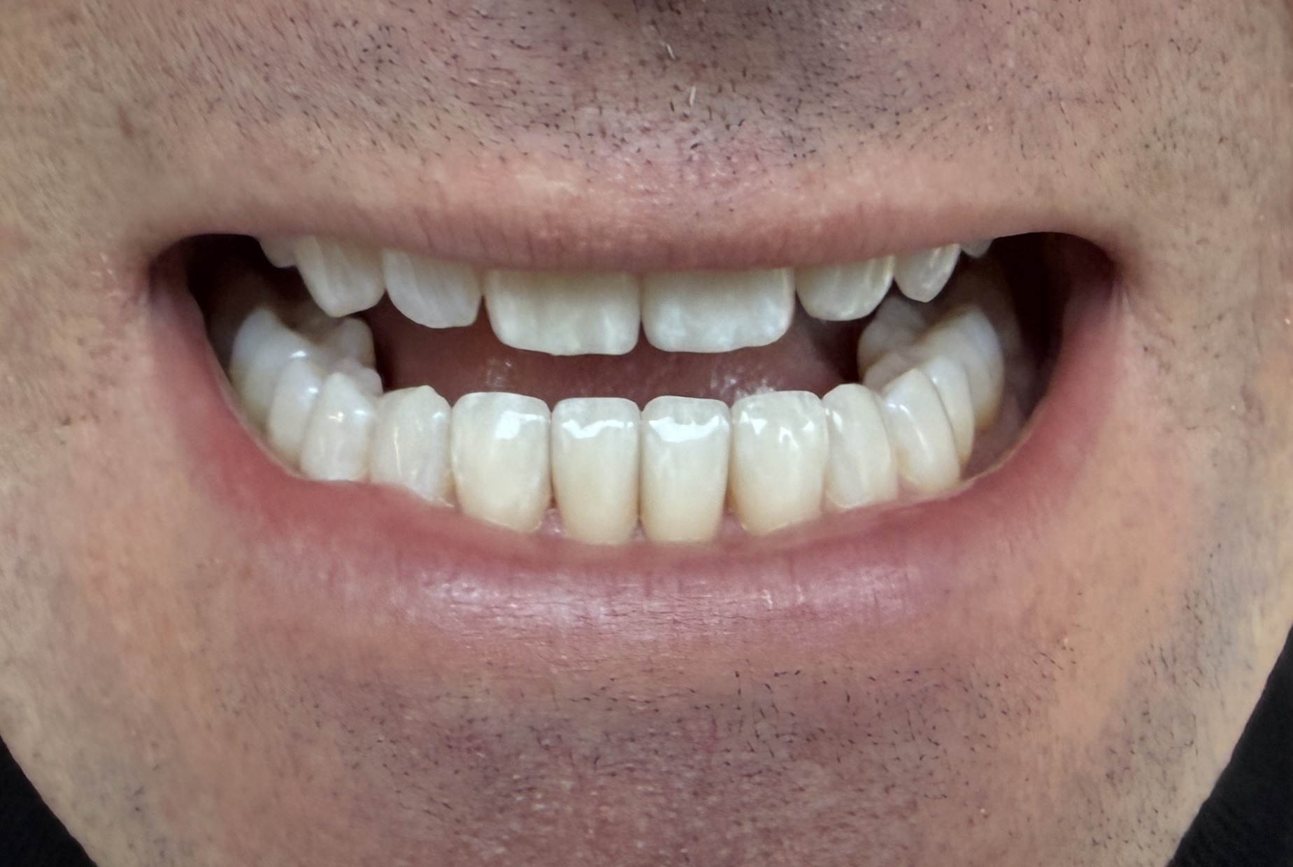 Veneers – Patientenbild frontal
