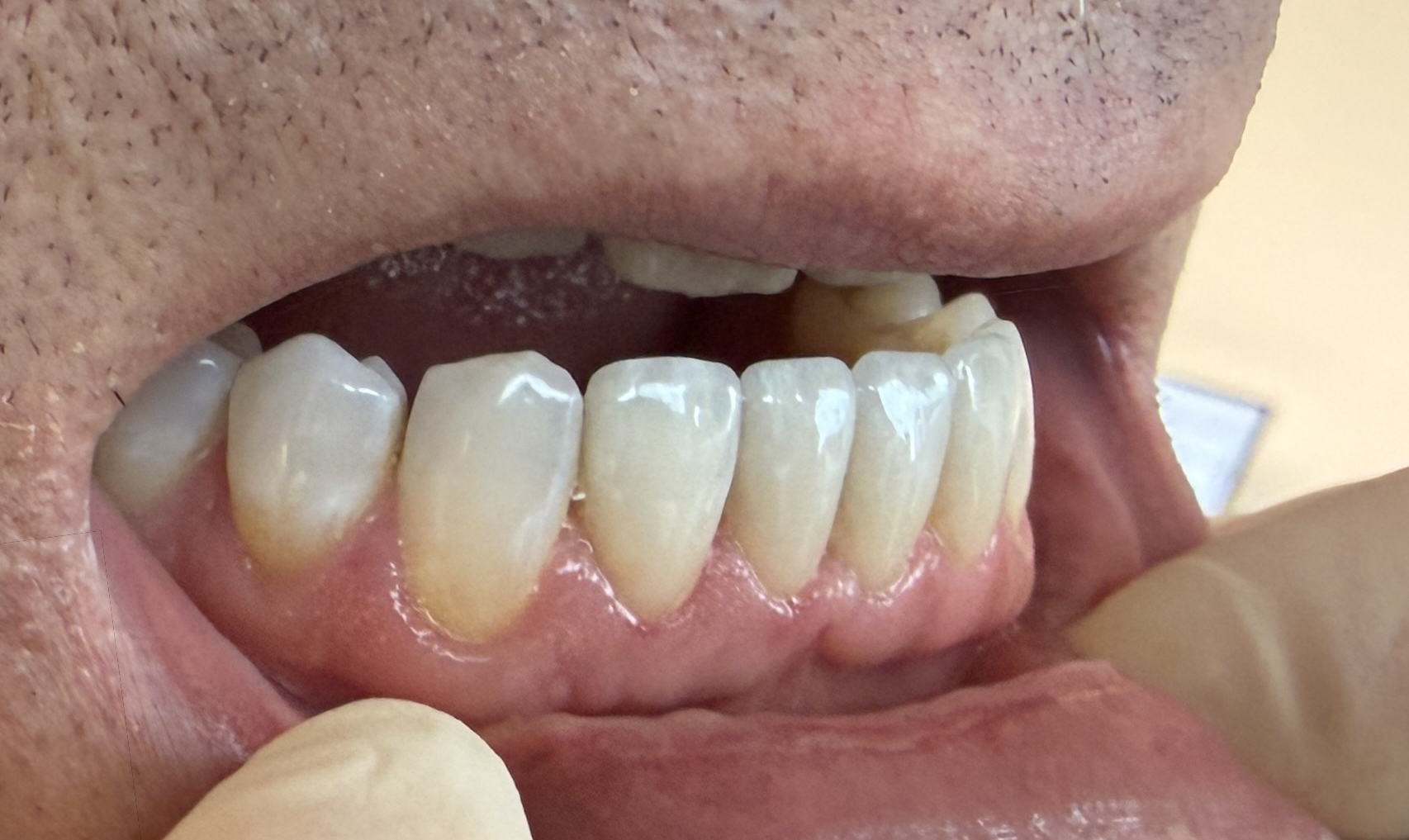 Veneers – Patientenbild seitlich