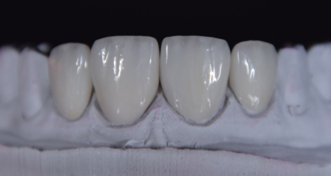 Veneers – Modell 2