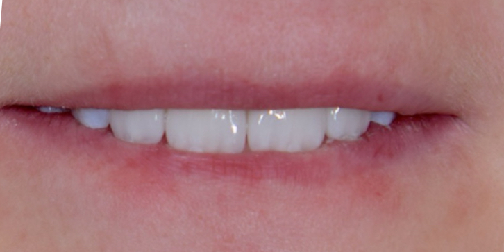 Veneers – Nachher