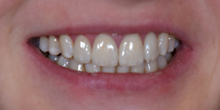 Veneers – Vorher