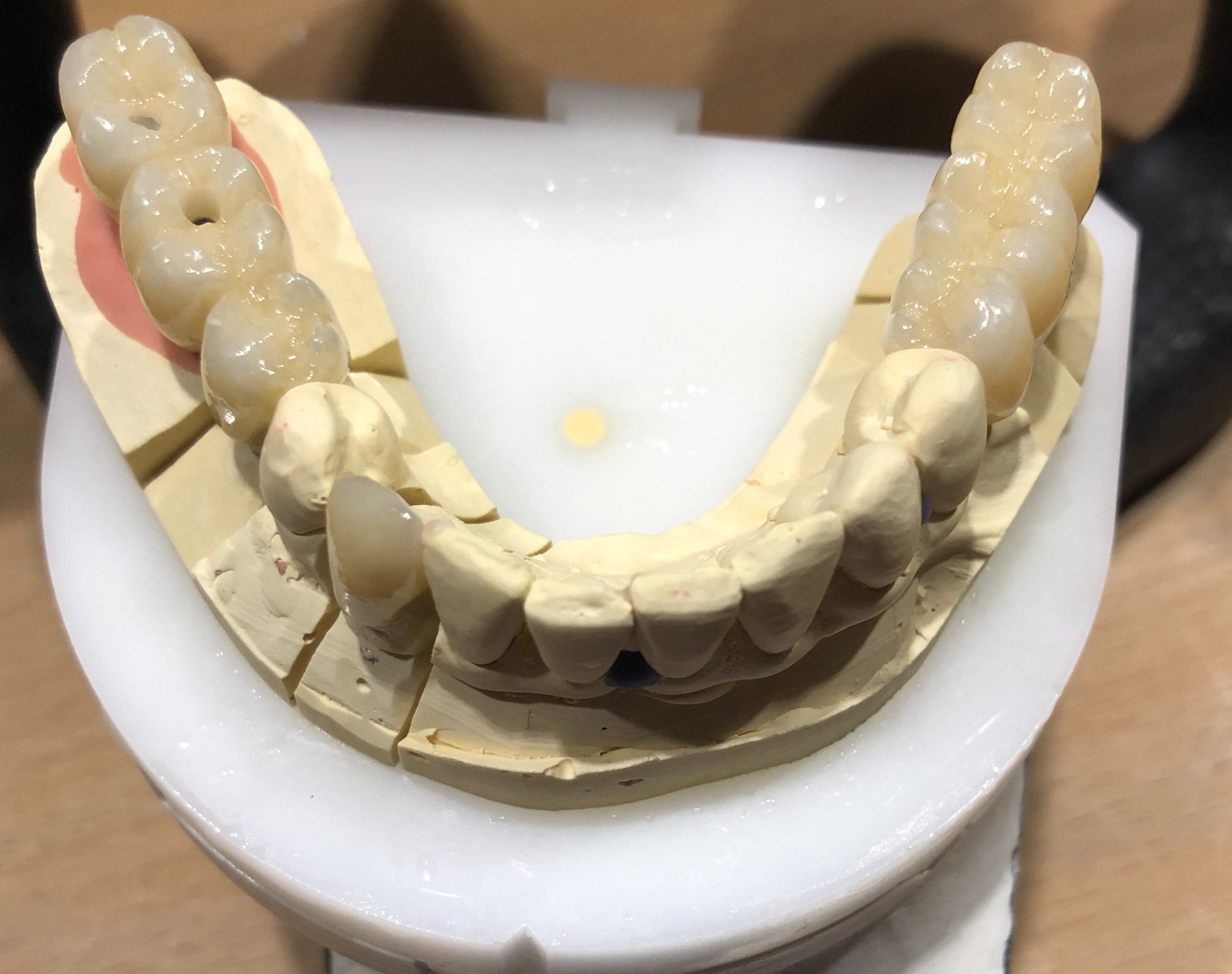 3er-Implantate – Modellfoto