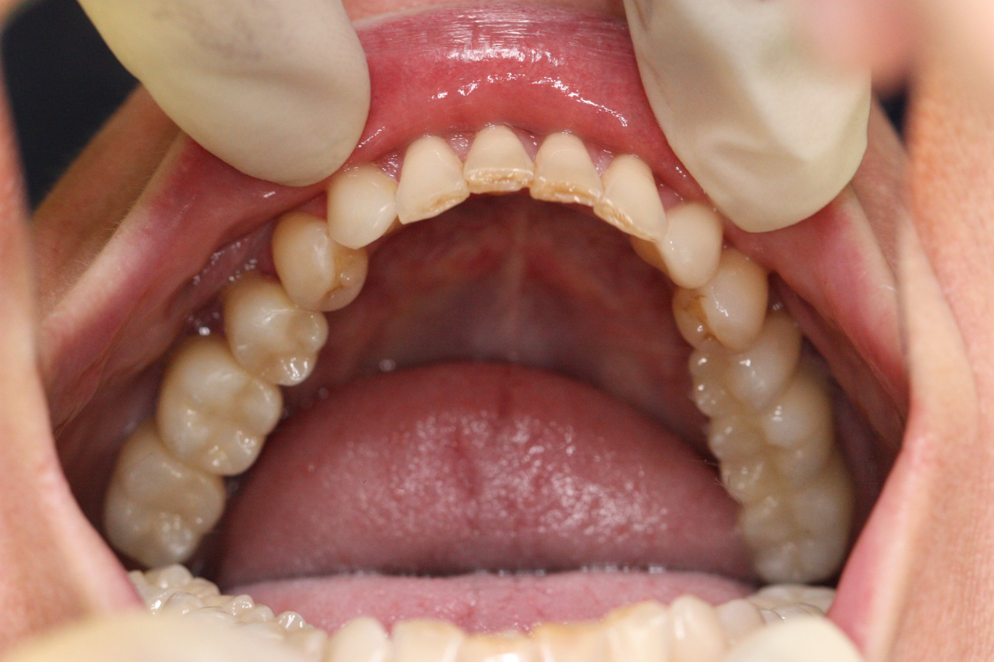 3er-Implantate – Patientenbild