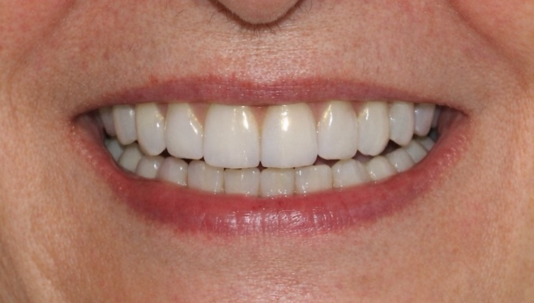 All on 4 – Nachher