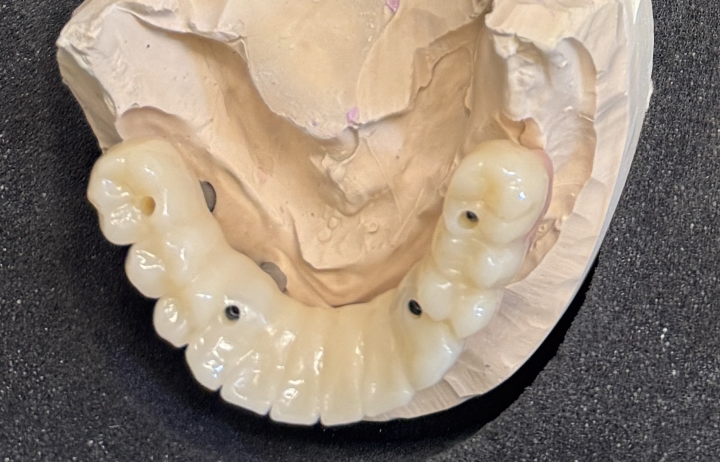 All on 4 – Modell Unterkiefer