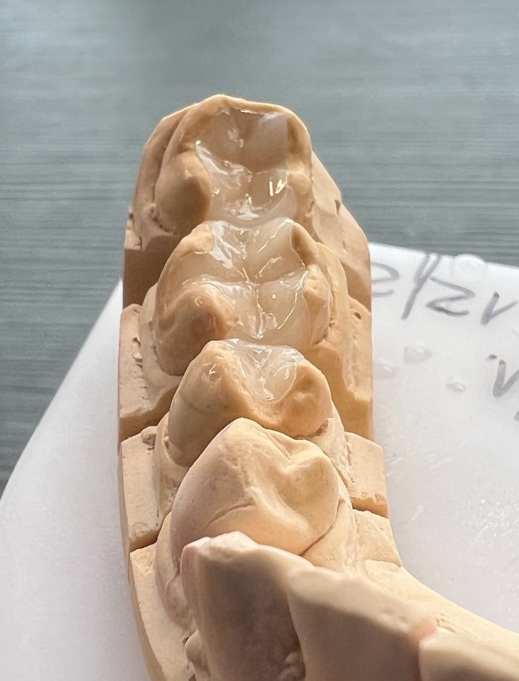 Keramikinlay – Wachsmodellation