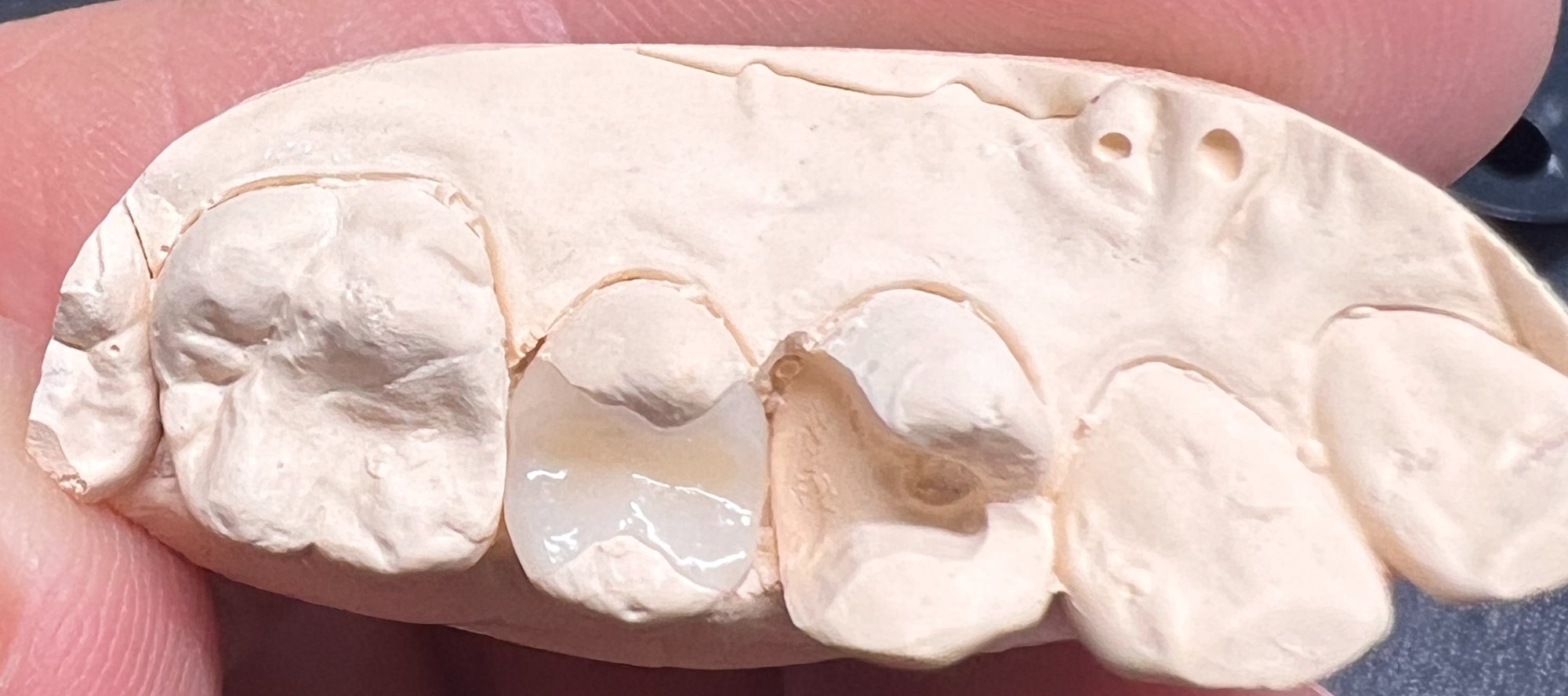 Keramikinlay – UK Modelle Vergleich