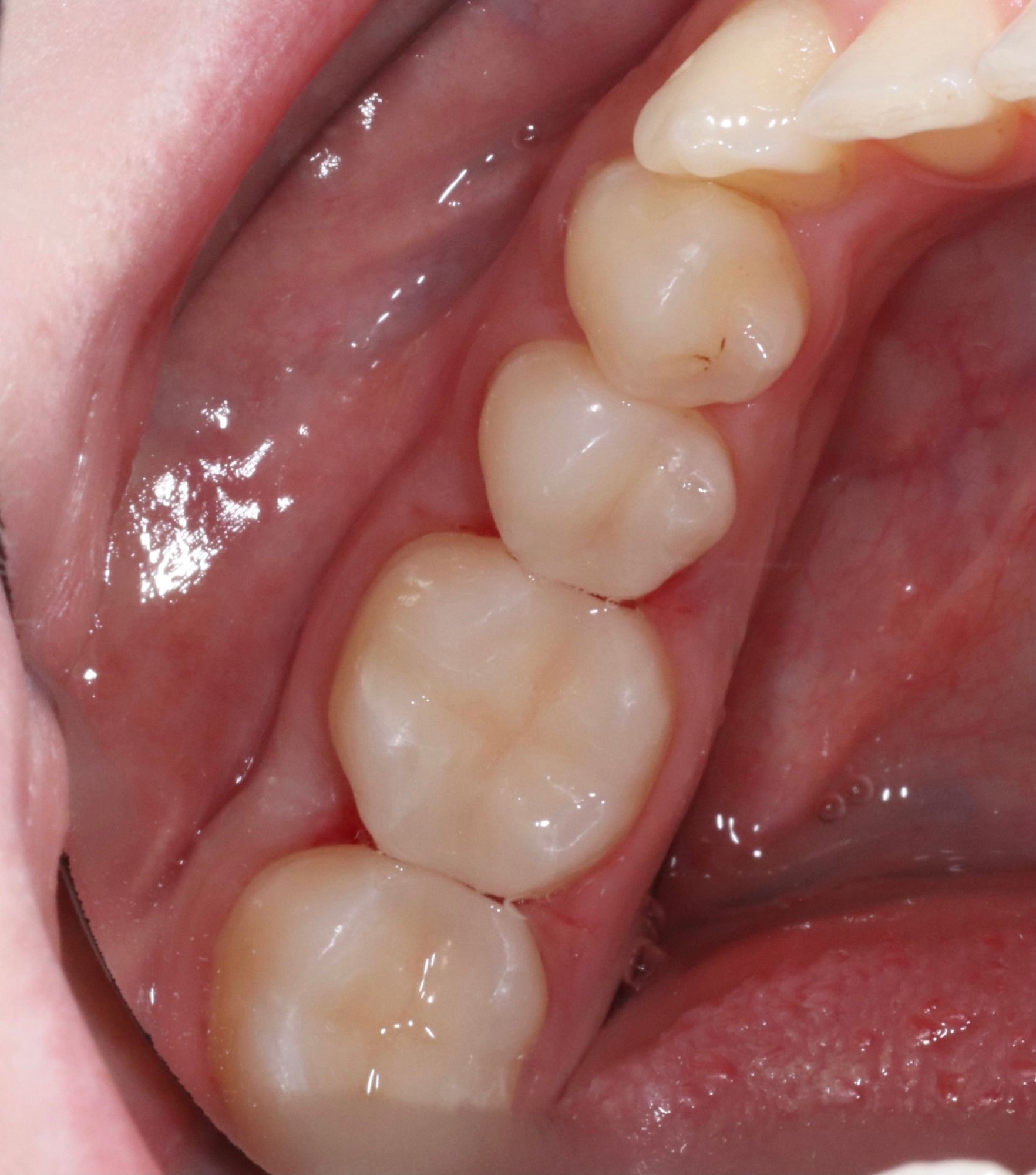 Keramikinlay – Inlay auf Modell