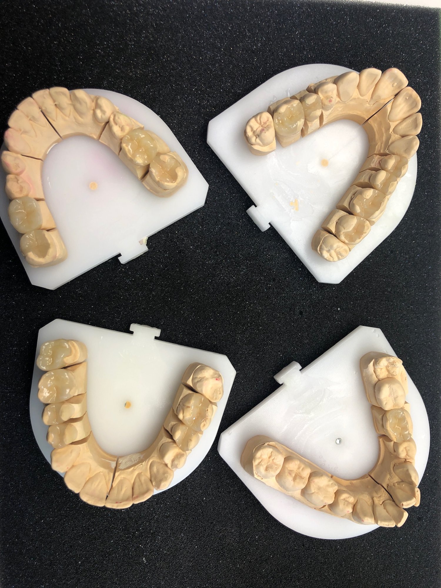 Keramikinlay – Sägeschnittmodell