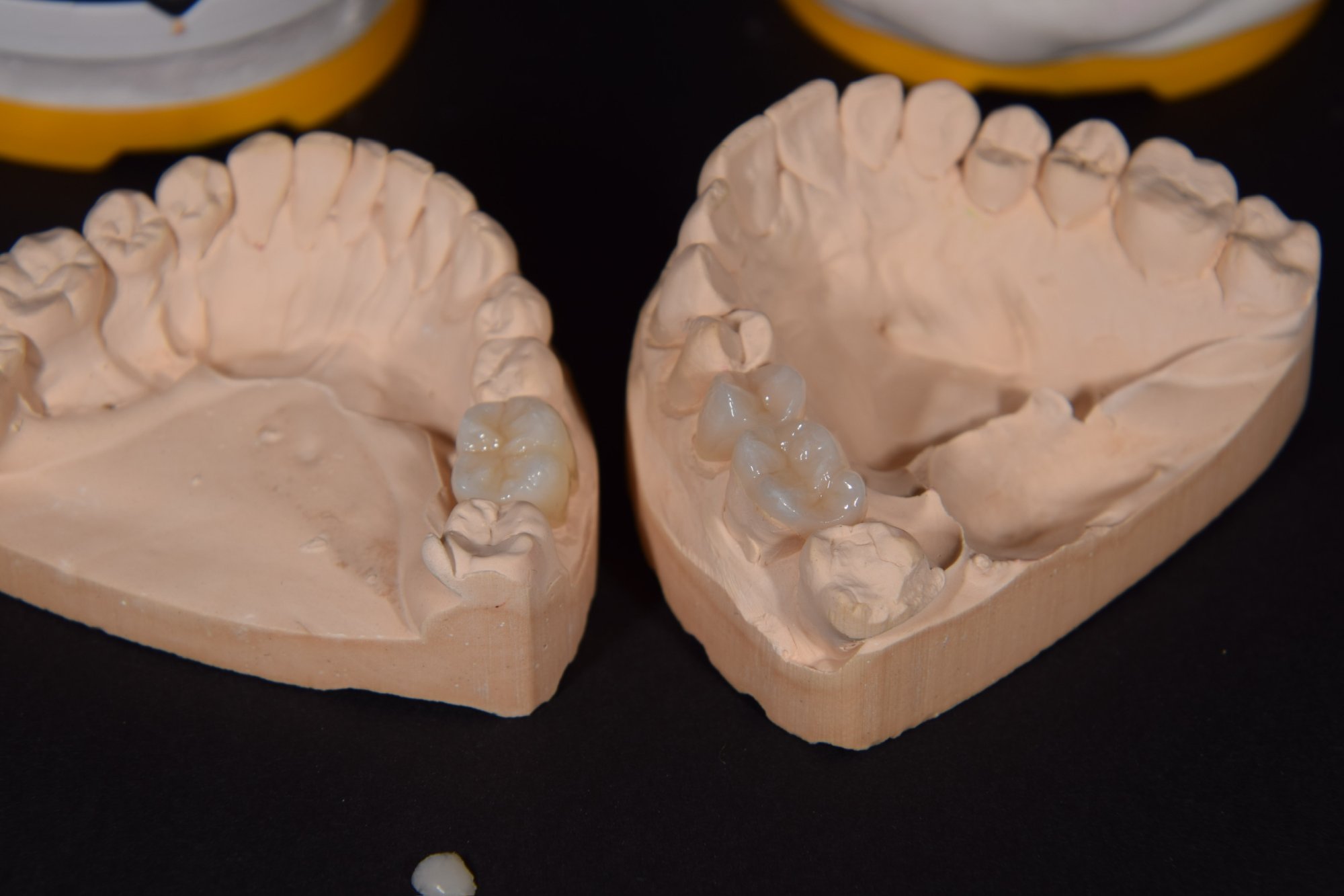 Keramikinlay – Eingesetzte Restauration