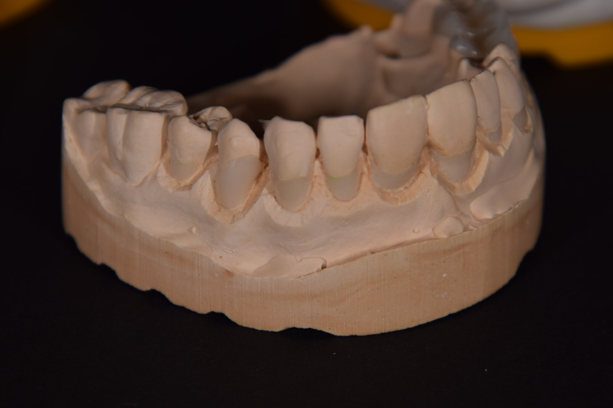 Keramikinlay – Sägeschnittmodelle Übersicht