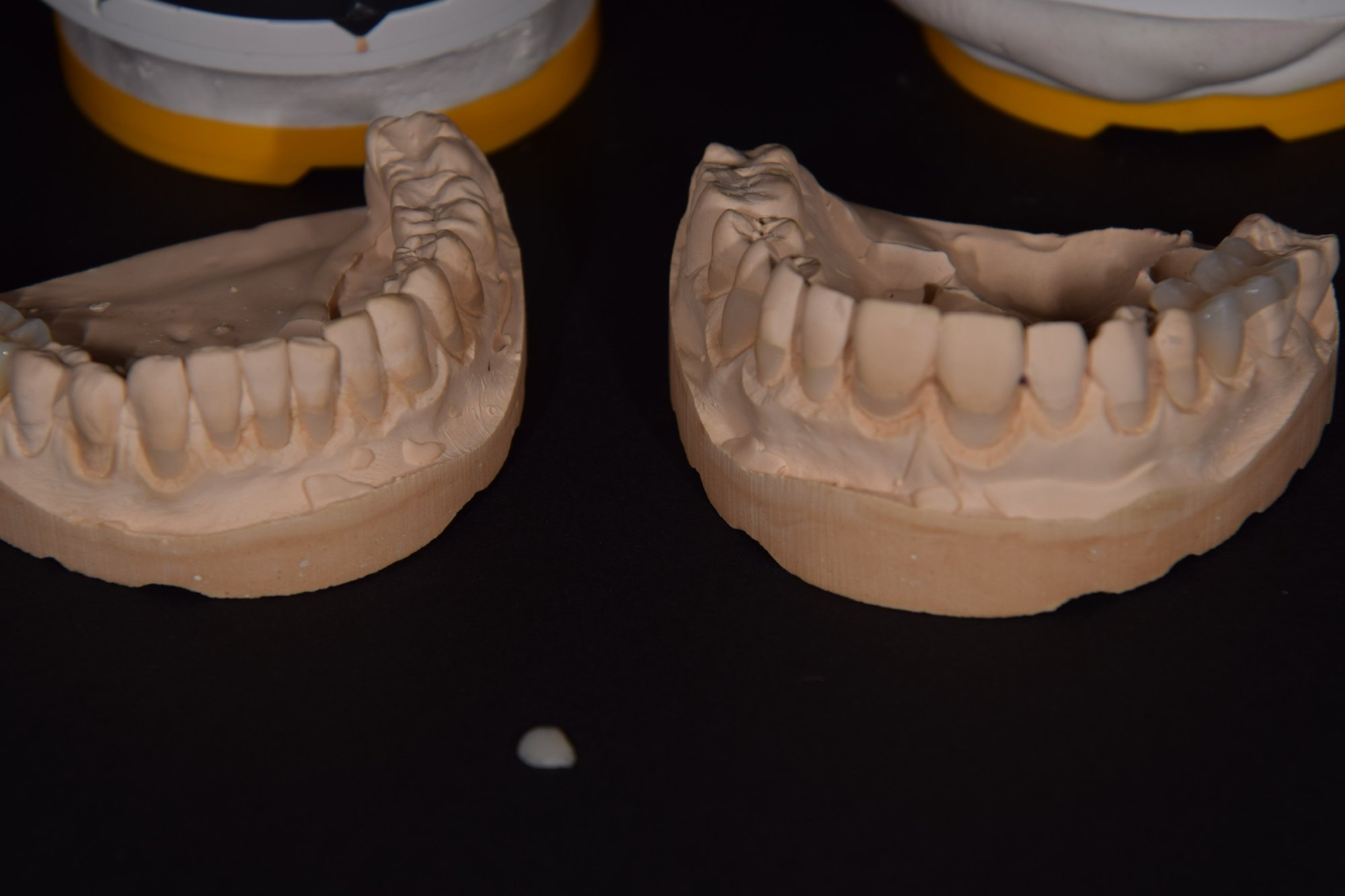 Keramikinlay – Unterkiefermodell