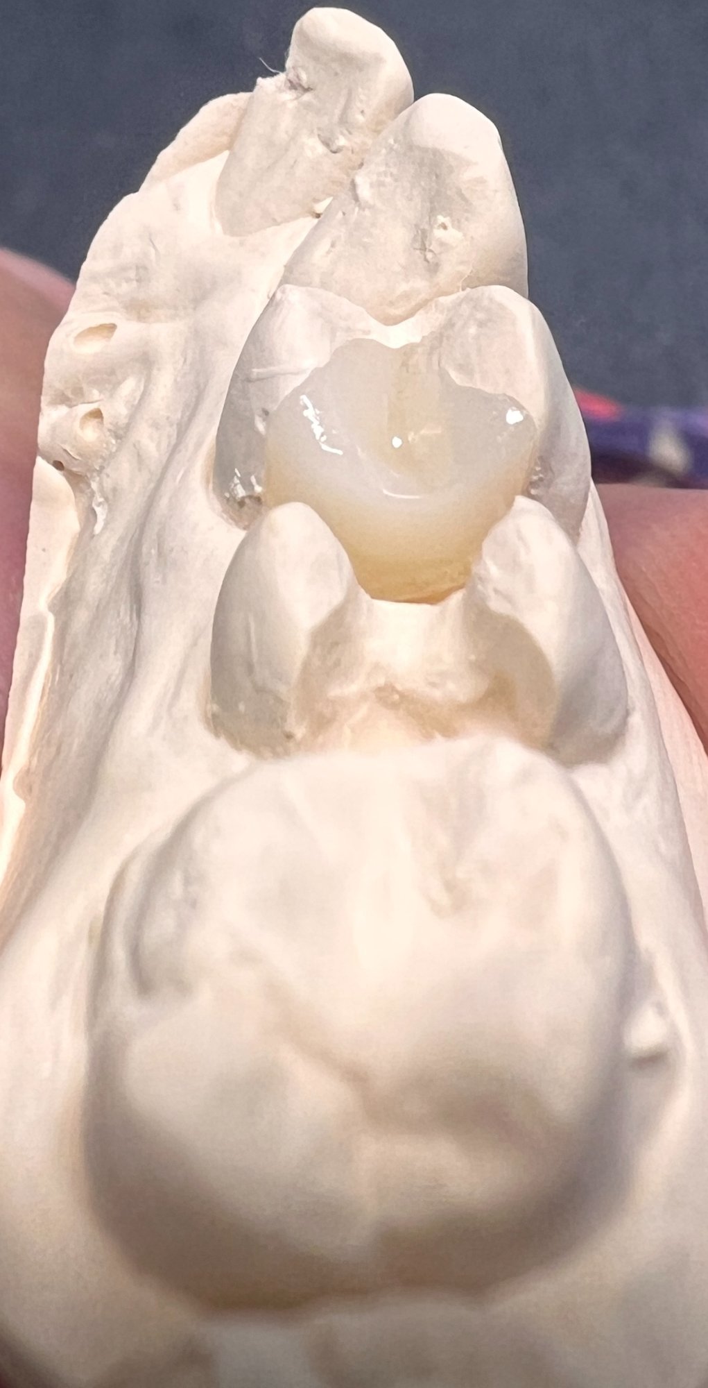 Keramikinlay – Modellpaar mit Inlays